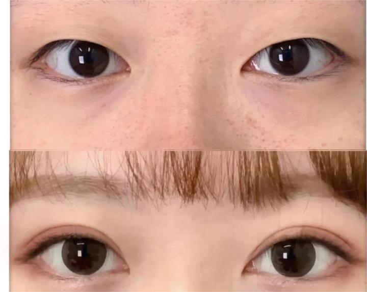 双眼皮还值得做吗?你适合哪种双眼皮?医院医生如何选择?价格如何? - 知乎