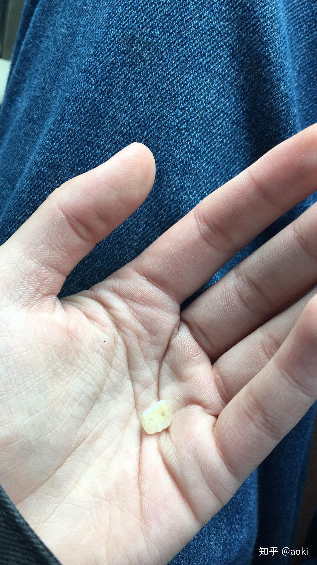 门牙掉了是一种怎样的体验