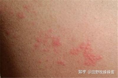 吃蜂蜜过敏是什么症状(蜂蜜吃了过敏了痒的我受不了怎么办) 吃蜂蜜过敏是什么症状(蜂蜜吃了过敏了痒的我受不了怎么办)