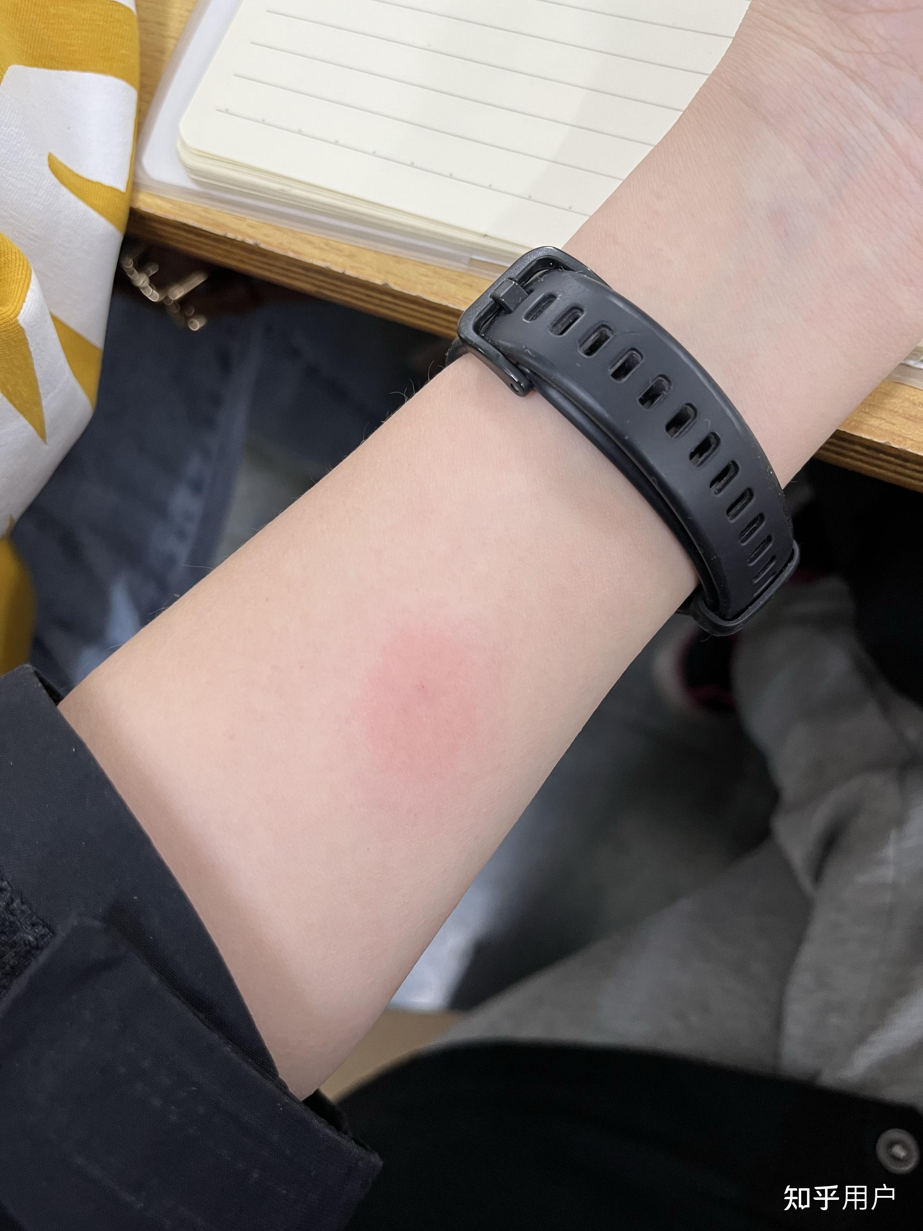 ppd皮试后这个样子怎么办? - 知乎