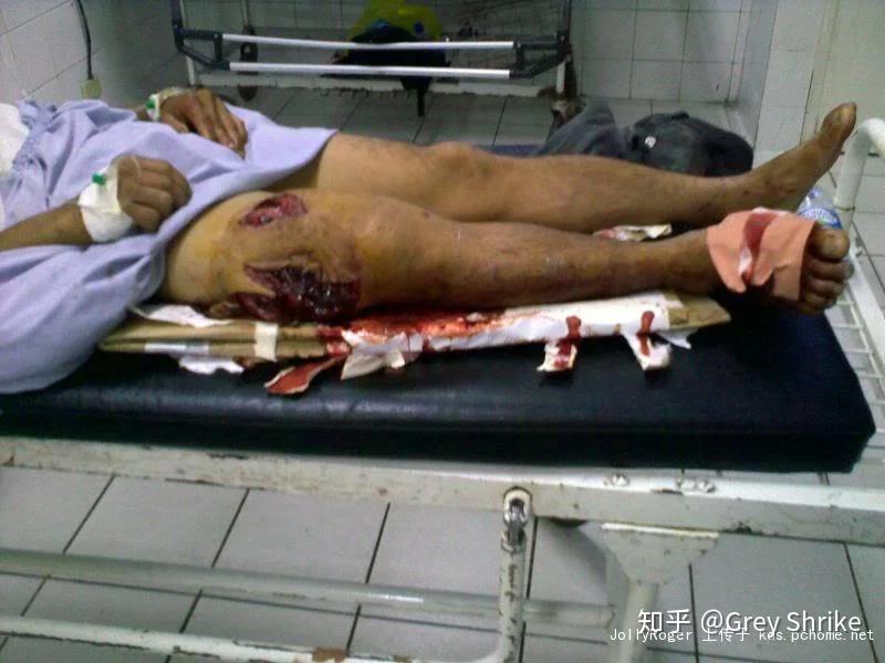 被枪打了之后是像电视里面一样只有一个孔吗