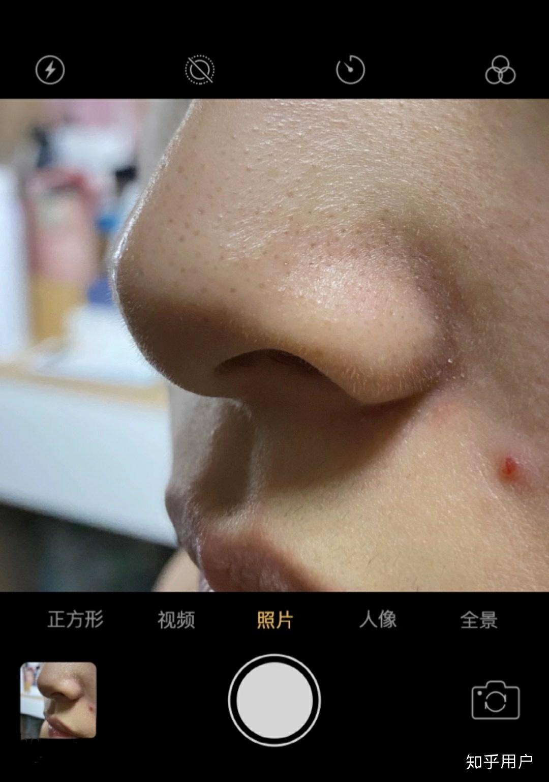 严重成这样的草莓鼻怎么办啊!求救啊! - 知乎