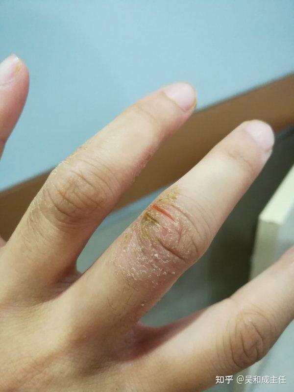 手指上出现了湿疹干裂本来一个指头有现在一双手上都有了怎么办