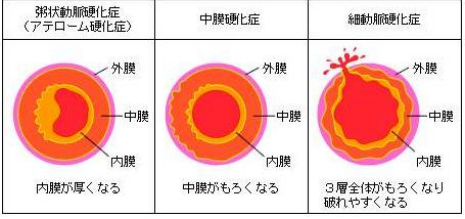 血管老化就是动脉硬化 - 知乎