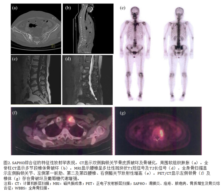 滑膜炎、痤疮、脓疱病、骨质增生和骨炎（SAPHO）综合征：回顾和更新！ - 知乎