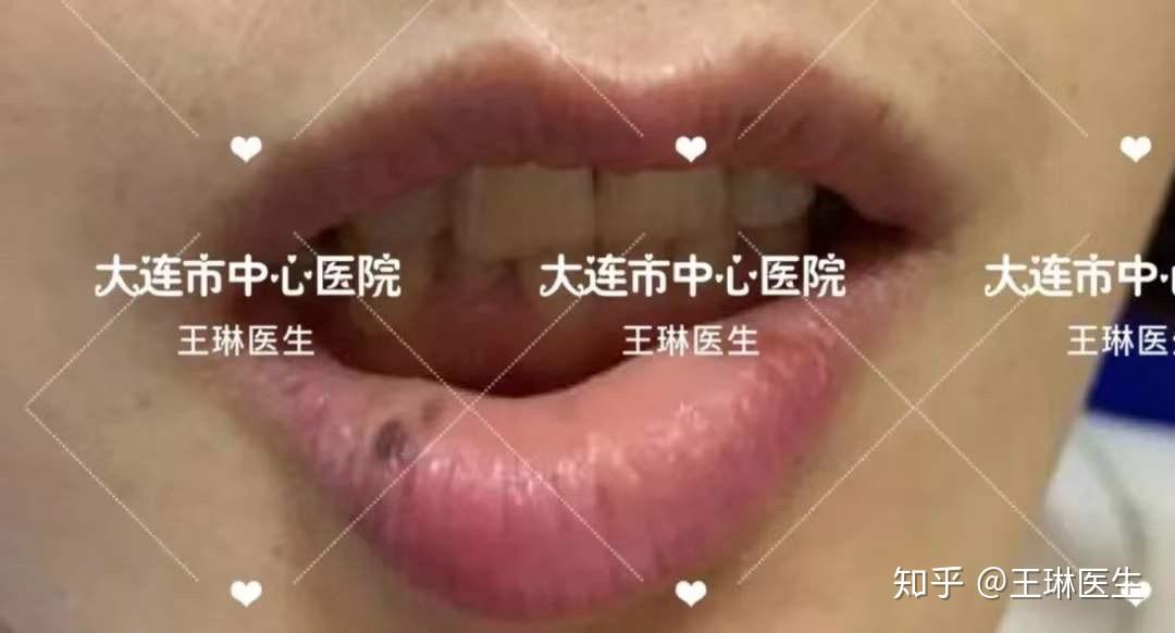 下嘴唇長黑斑是什麼原因