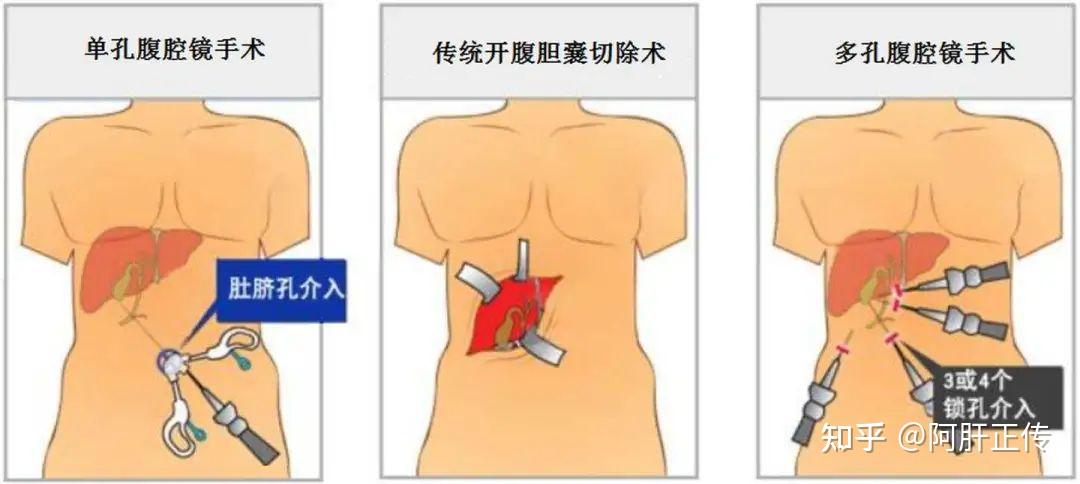 胆囊炎胆结石是切除好还是保胆好? 