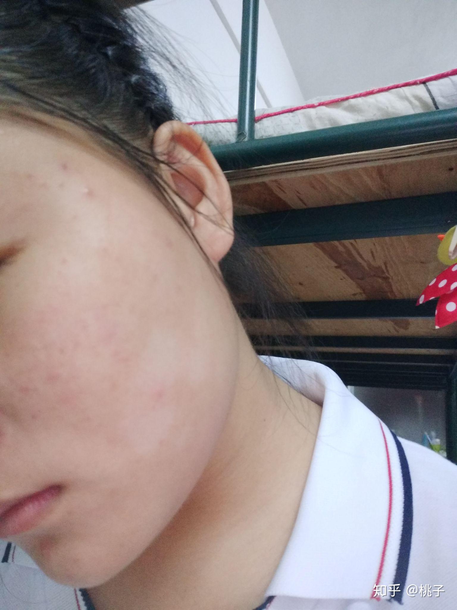 我一个女生脸上长花斑癣可怎么办阿? - 知乎
