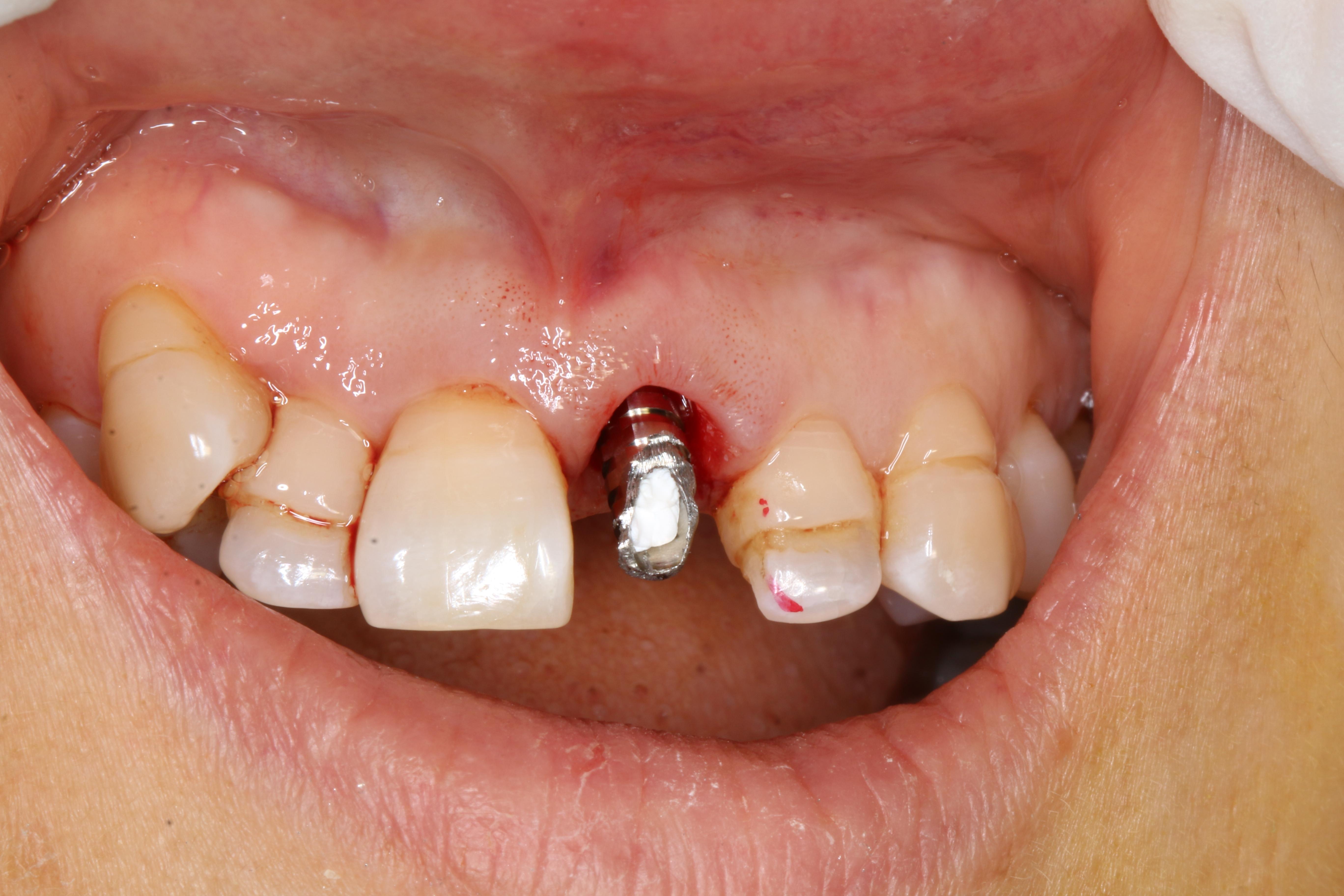 上门牙外伤即刻种植即刻修复