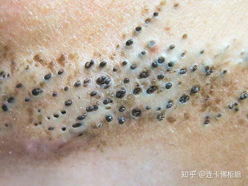 之前挤黑头把鼻子挤出好多洞特别是图上那个超级大今天实在受不了就挤