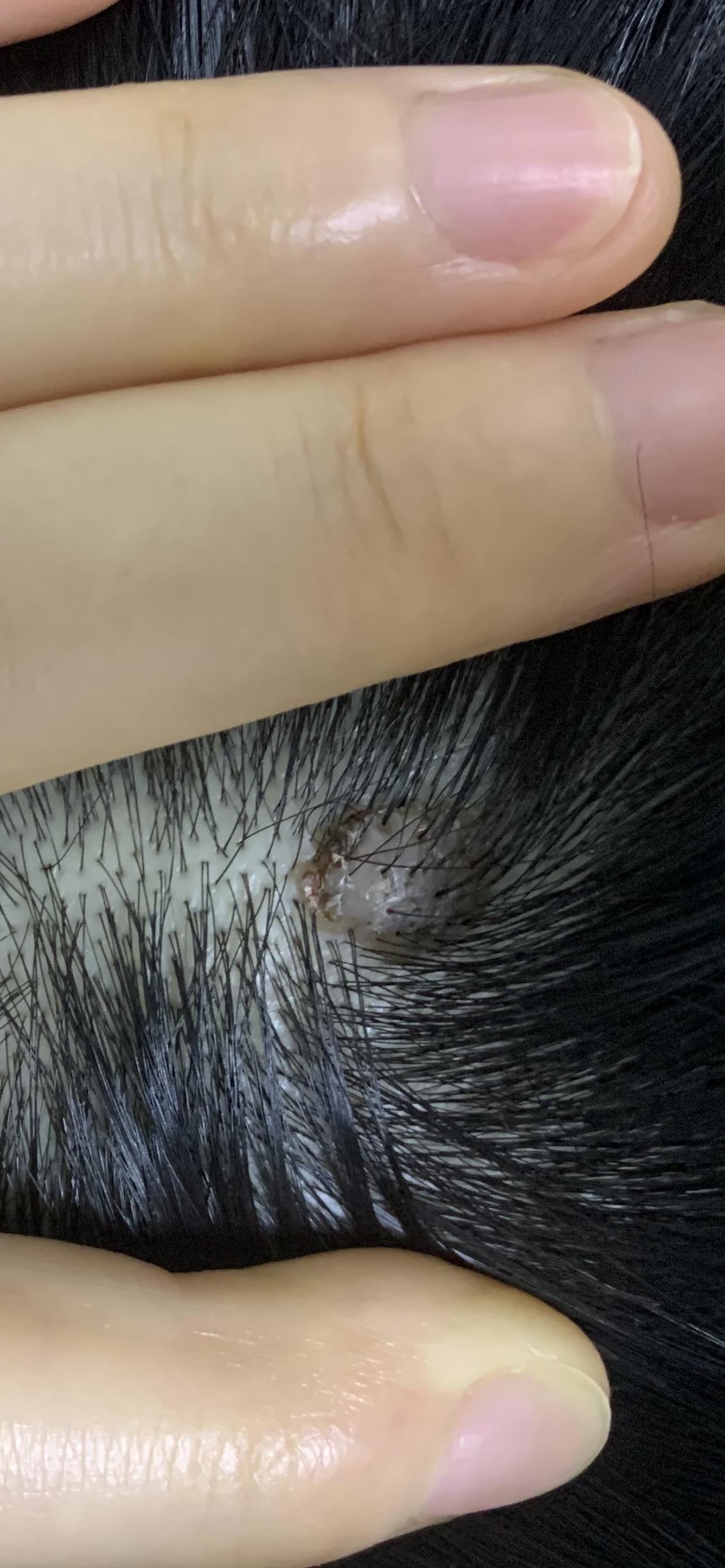 头发里的这个是痣吗