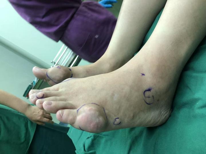 从患者脚上取出的"鸡蛋":痛风石实录