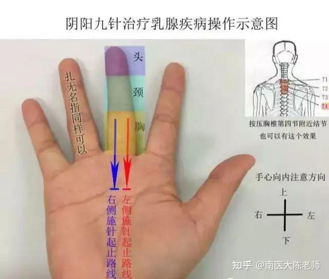 特效乳腺针法(九针变式、藏针、放血) - 知乎