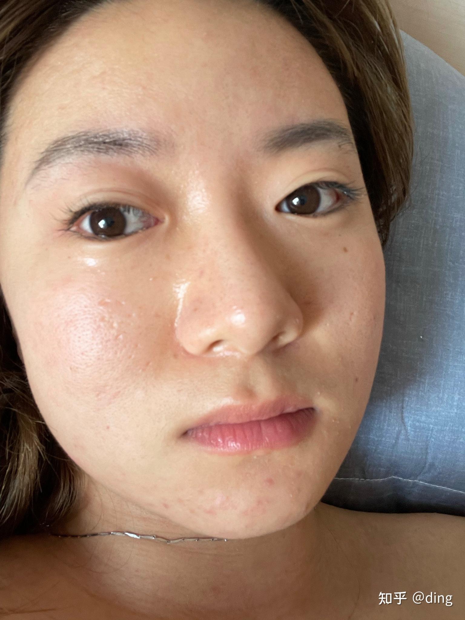 皮肤屏障受损怎么修复比较安全? - 知乎