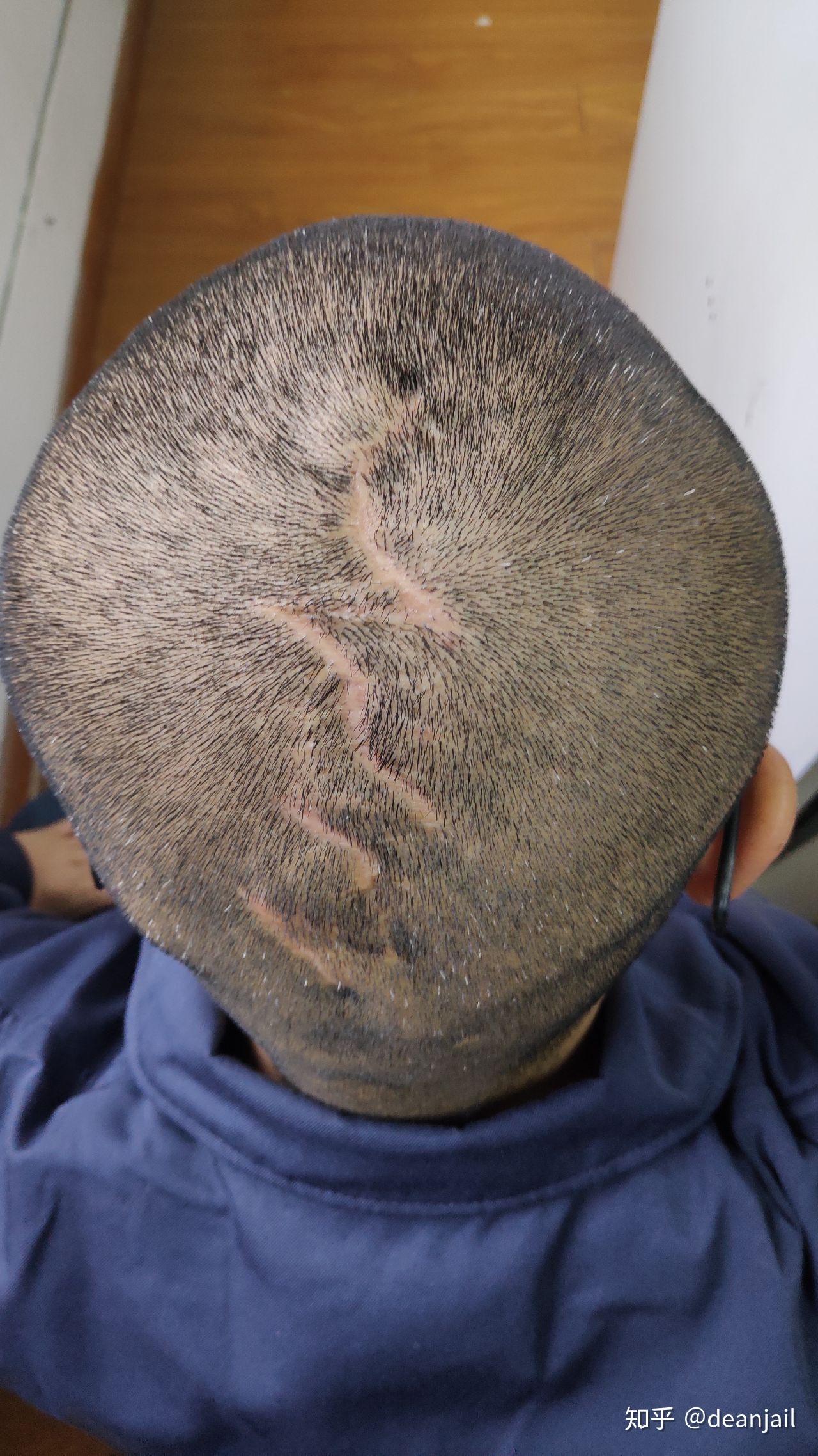 头皮手术中,皮瓣转移和埋扩张器两种方法产生的疤痕哪个更大? 