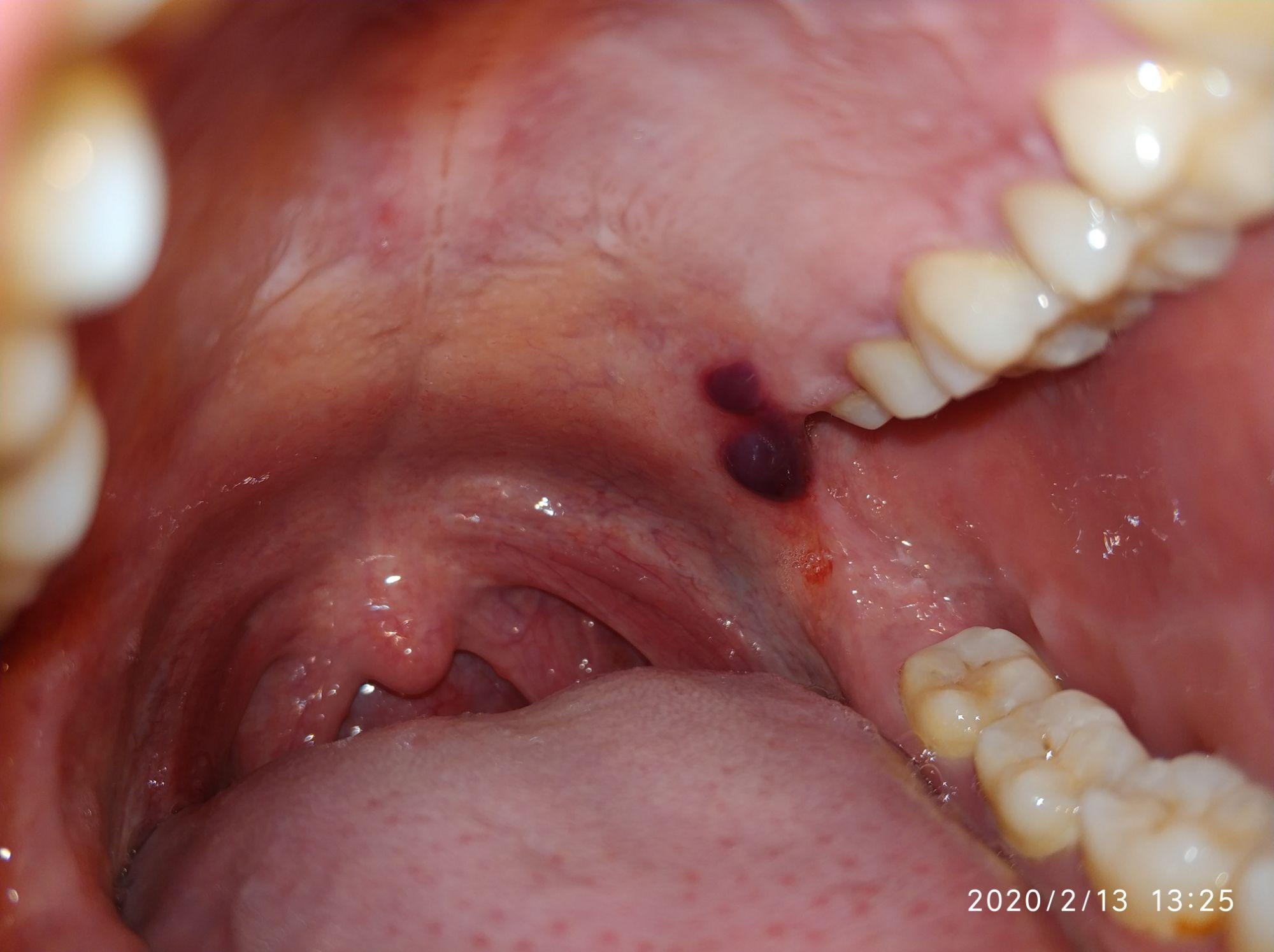 口腔内壁血泡图片