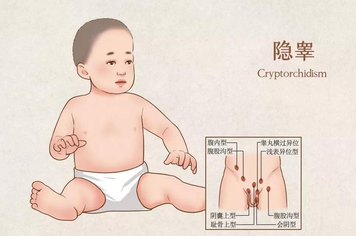 洗澡时发现宝宝蛋蛋不见了警惕隐睾