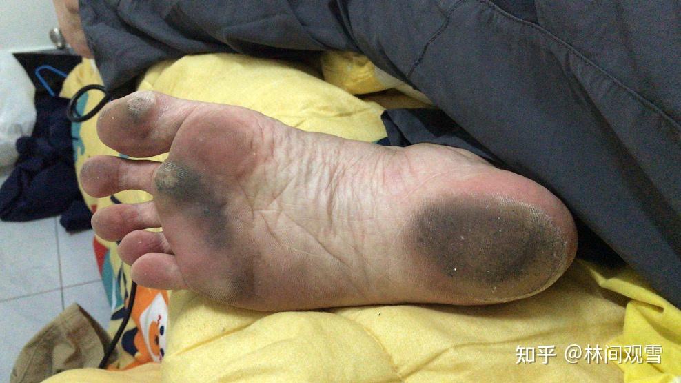赤脚跑步跑出一脚老茧是什么样的体验