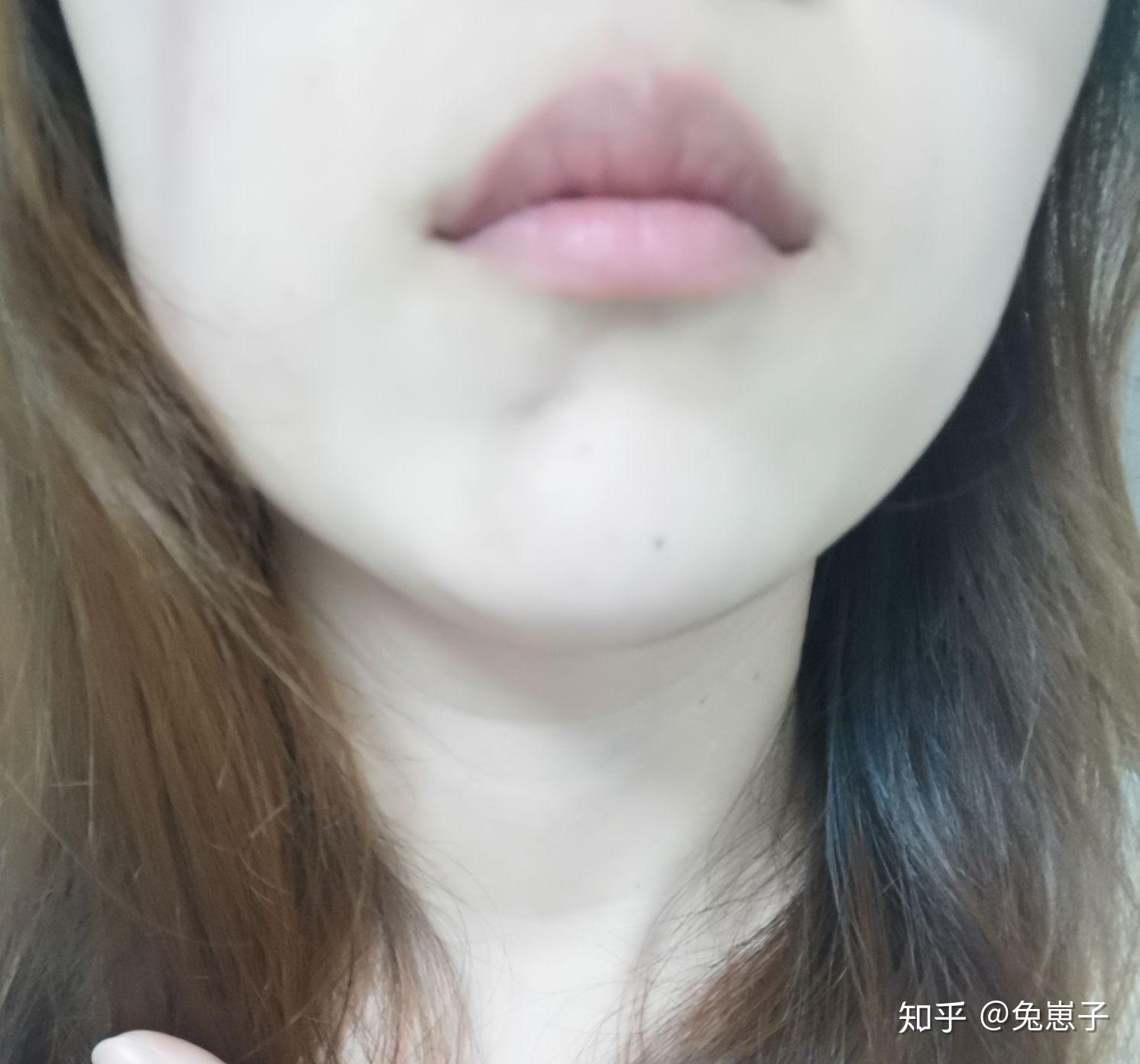 24岁女得了皮下脂肪萎缩下巴凹陷一块怎么办