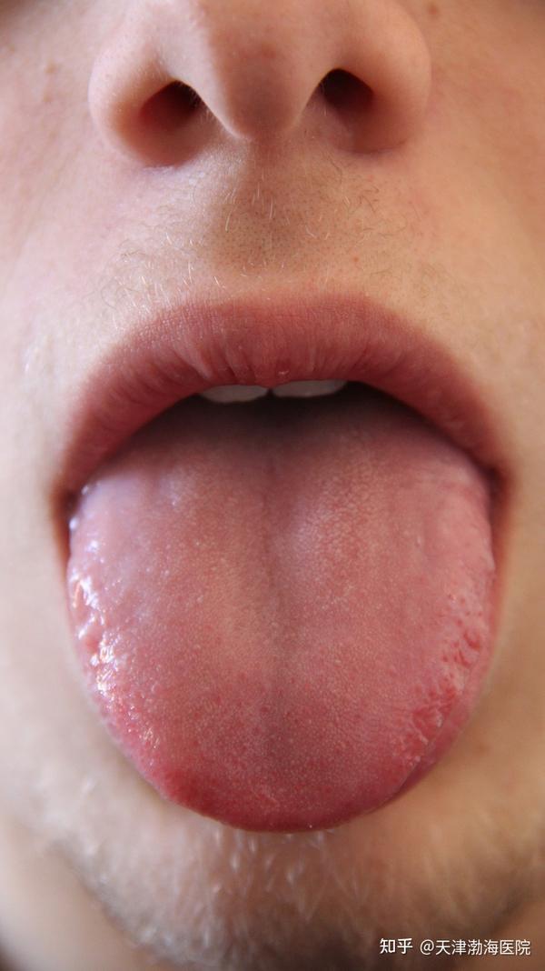 舌苔突然白厚是什么原因