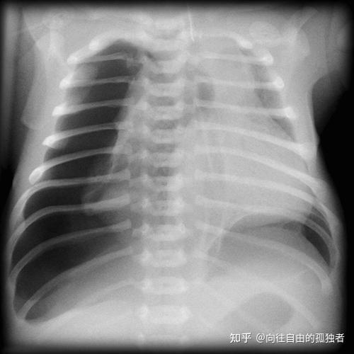 气胸有哪些表现?致病原因是什么?该如何预防和治疗呢? - 知乎