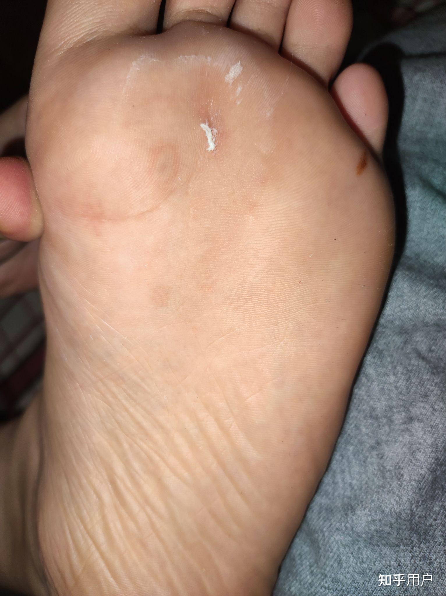被蚊子咬到脚底板或其他更敏感的部位是什么体验? - 知乎