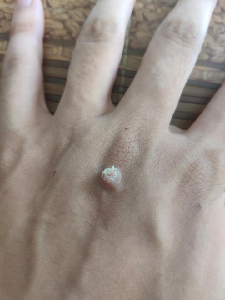 身上长了瘊子怎么治中医良方轻松治