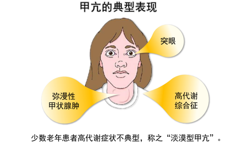 「甲亢」产生的原因是什么,如何预防? - 知乎