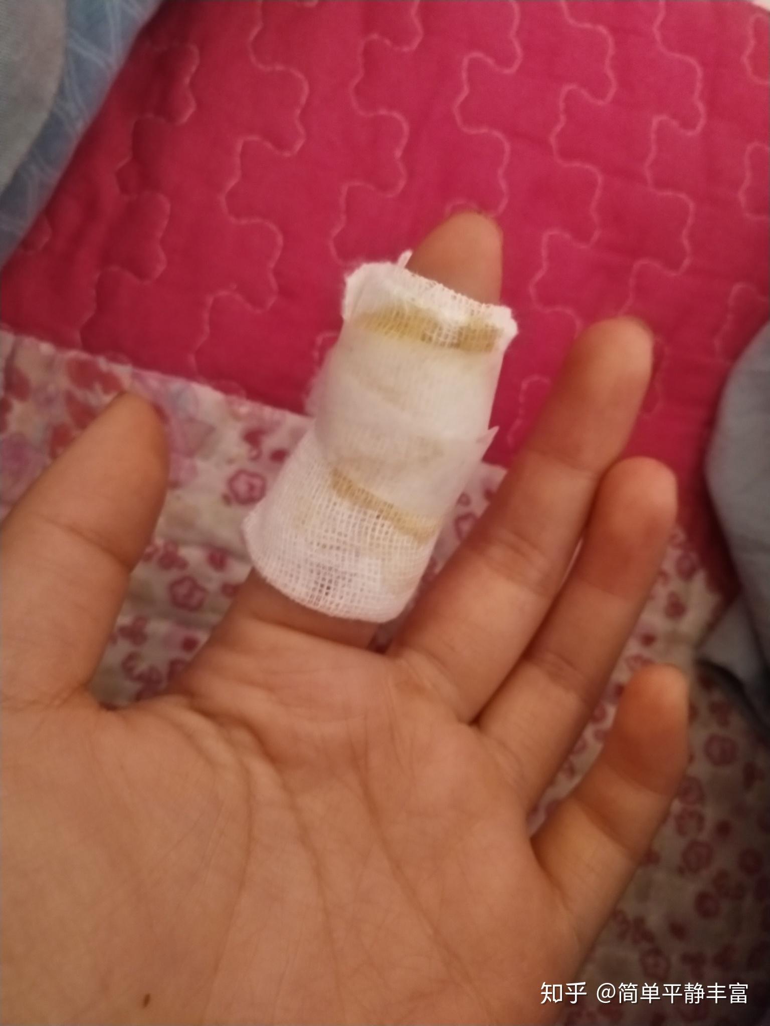 手指头扎了一个小刺刺弄不出来咋办