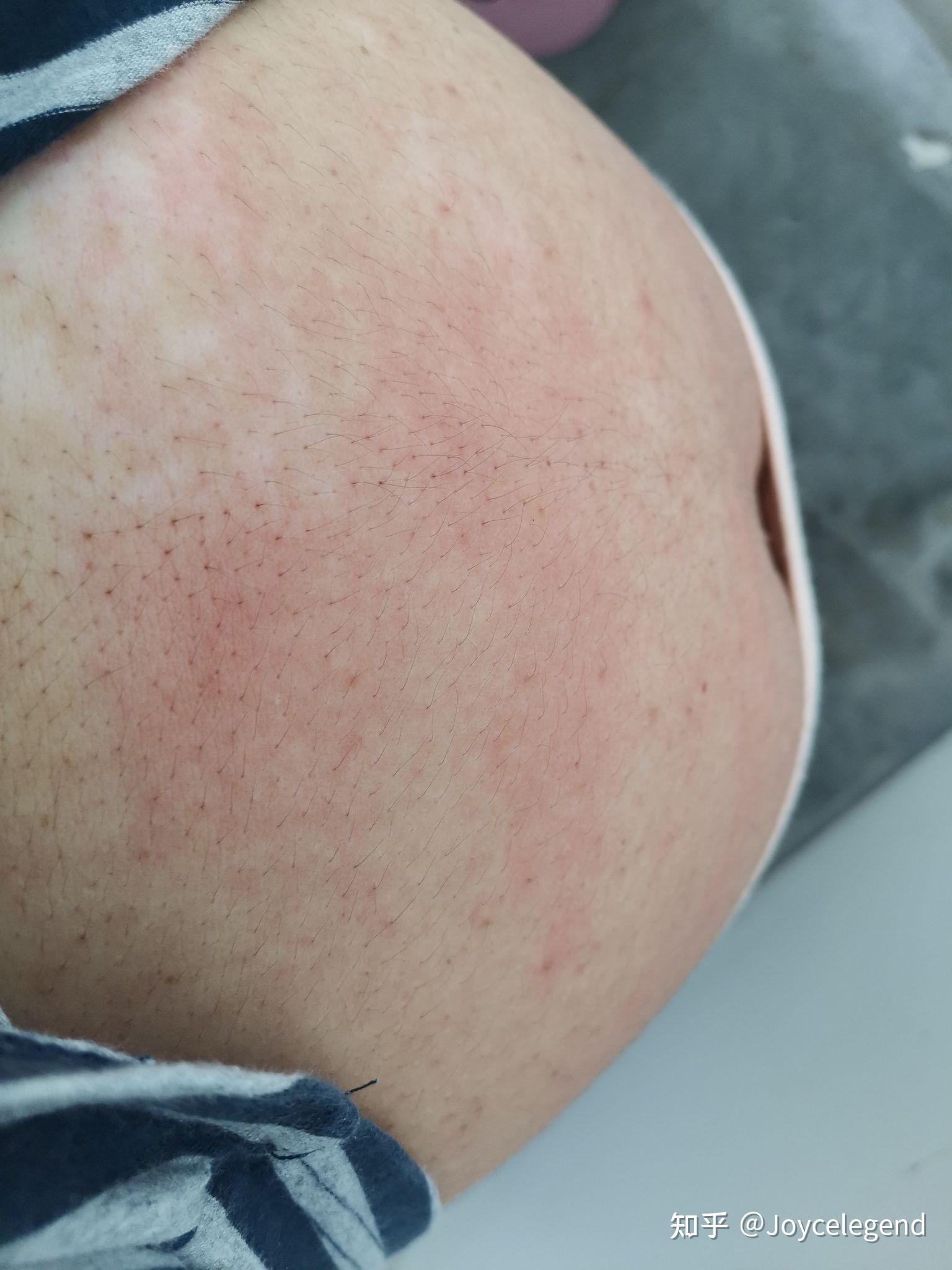 孕晚期孕妇身上长湿疹怎么办? - 知乎