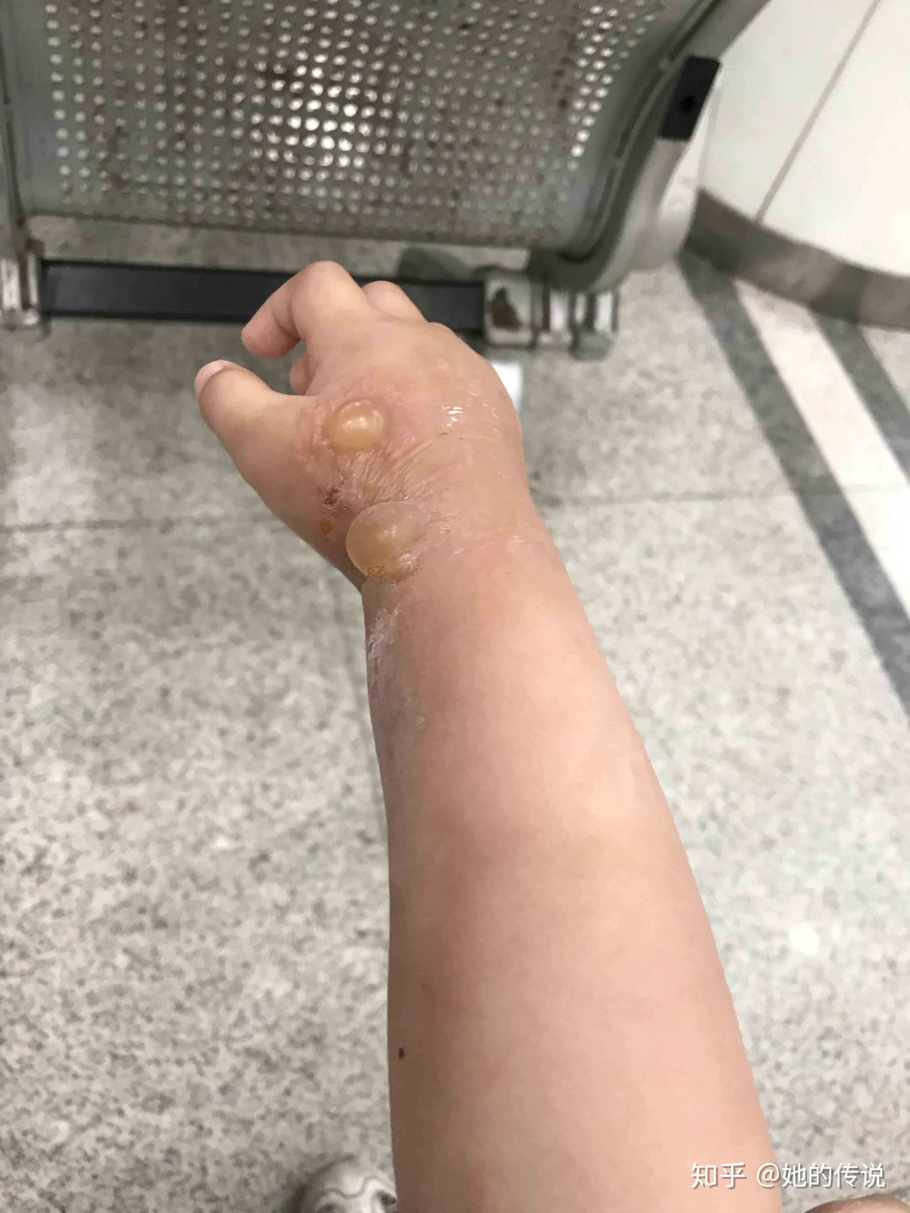 被隐翅虫咬了怎么治?让他自己好?还是要看医生? - 知乎