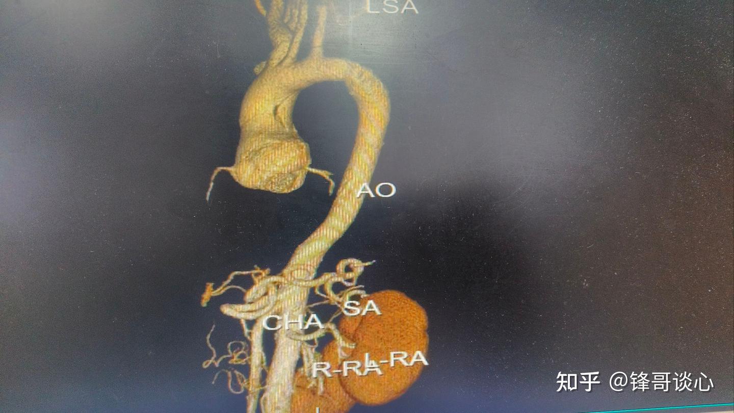 主a型主动脉夹层急诊手术.主动脉夹层解剖变异. - 知乎