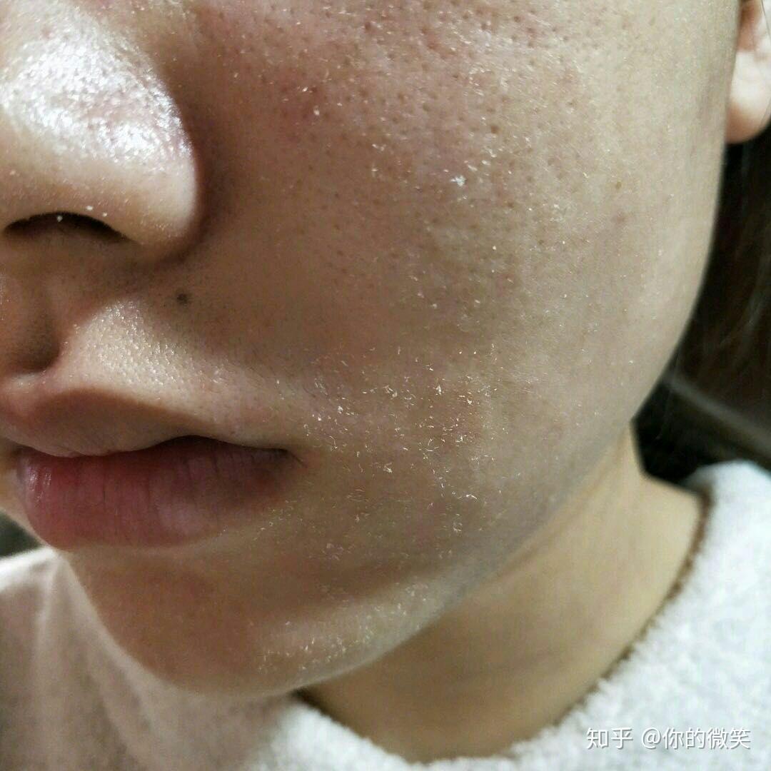 脸上老是起皮怎么办? - 知乎