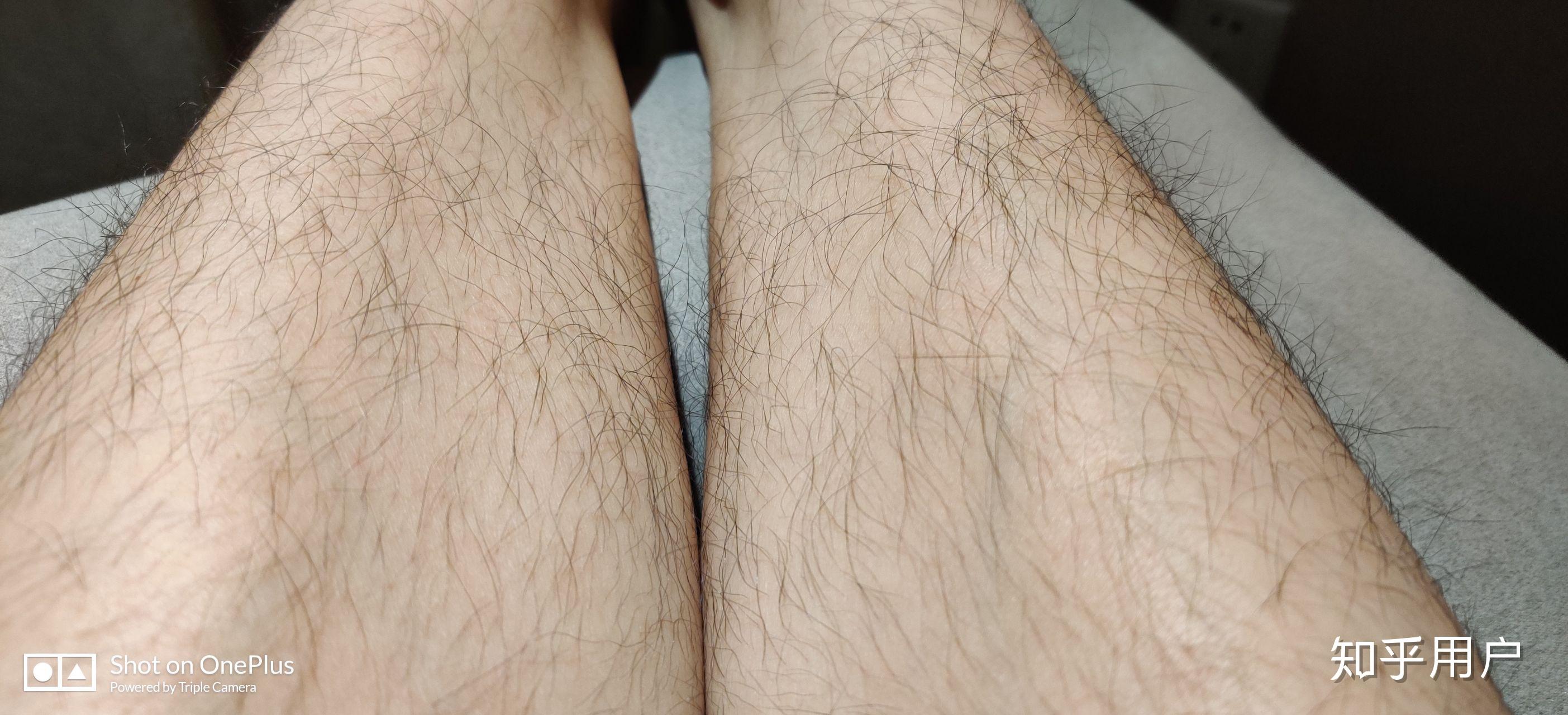腿毛真的会越刮越多吗?