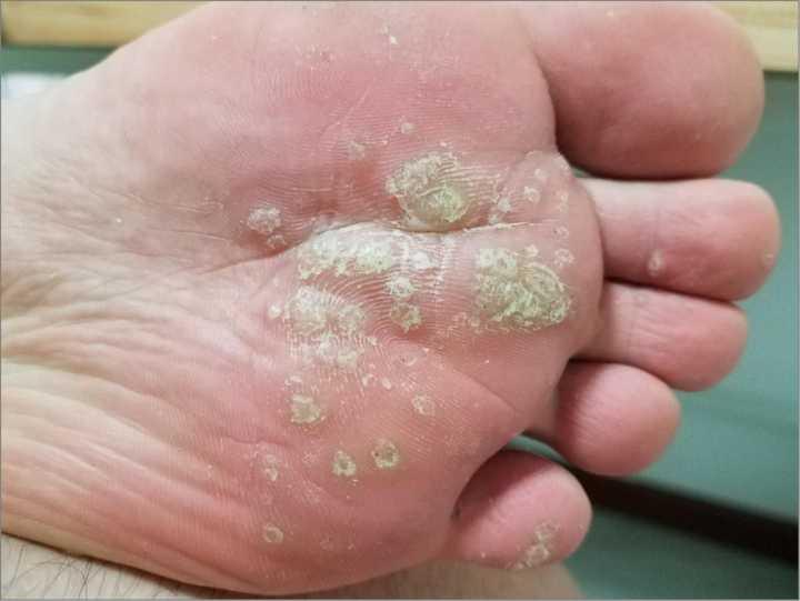 女性脚上长了跖疣会长宫颈癌吗