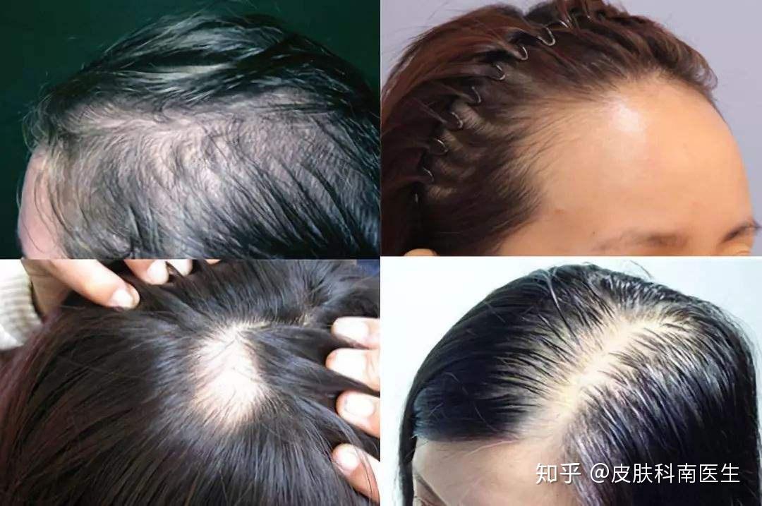 女性脂溢性脱发最佳治疗方案(女性脂溢性脱发怎么治疗最有效)