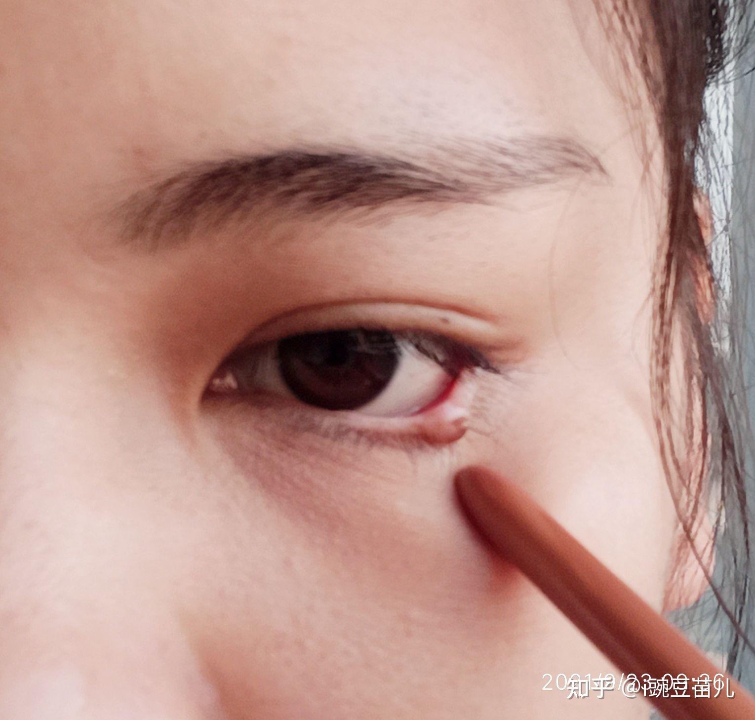 长在下眼皮的痣可以点了吗