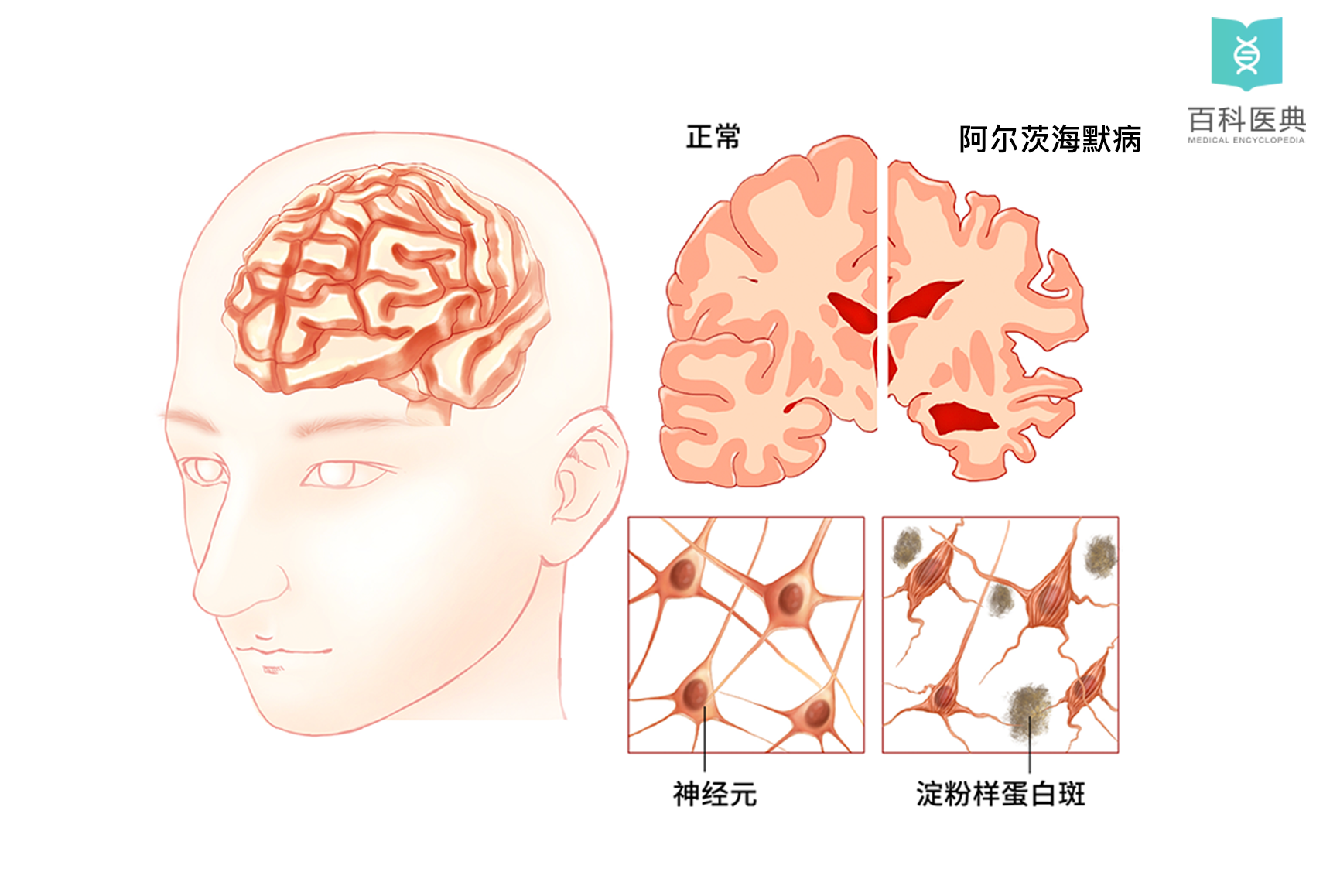 抑郁症对大脑的损害是永久性的吗