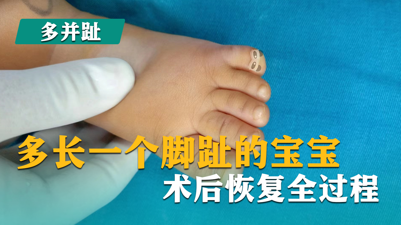 8个月大宝宝小趾多并趾像个小爱心免植皮手术后基本看不出来