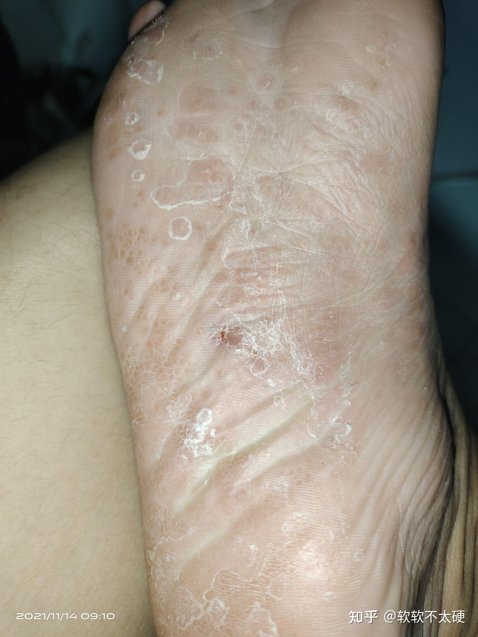 脚底板皮肤裂口这两天才发现还有整个脚四周皮肤都很硬下面有图要涂