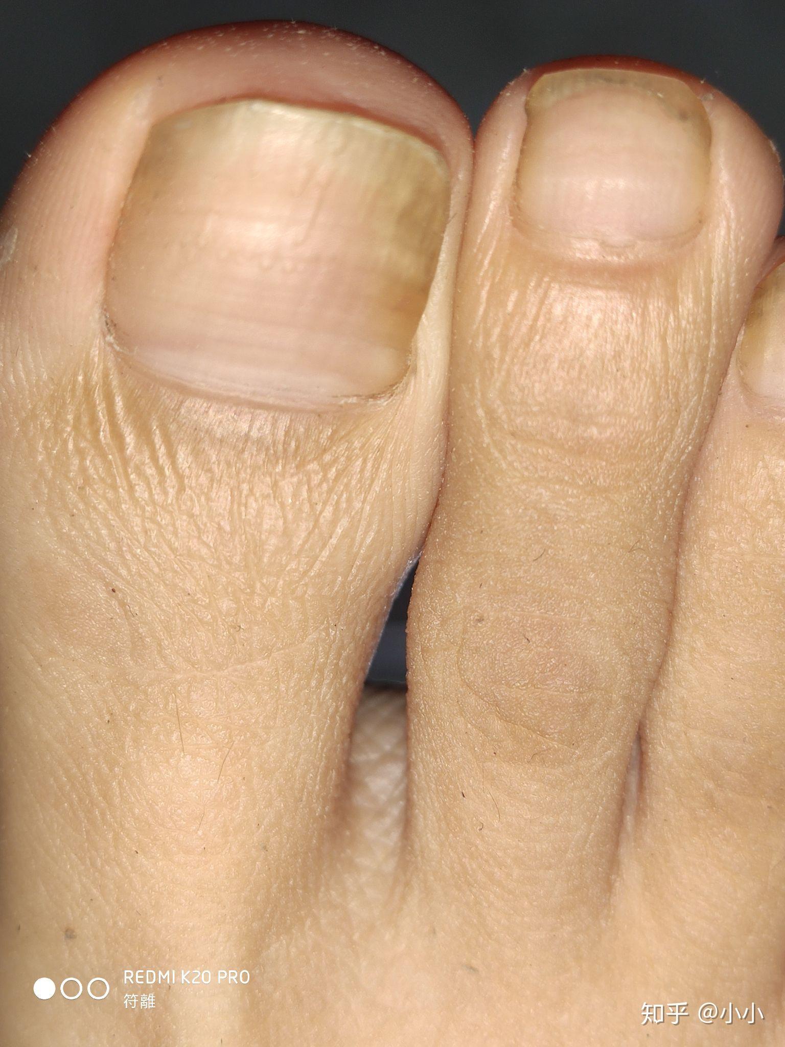 脚指甲无缘无故就空了,是灰指甲吗?要怎么治? - 知乎