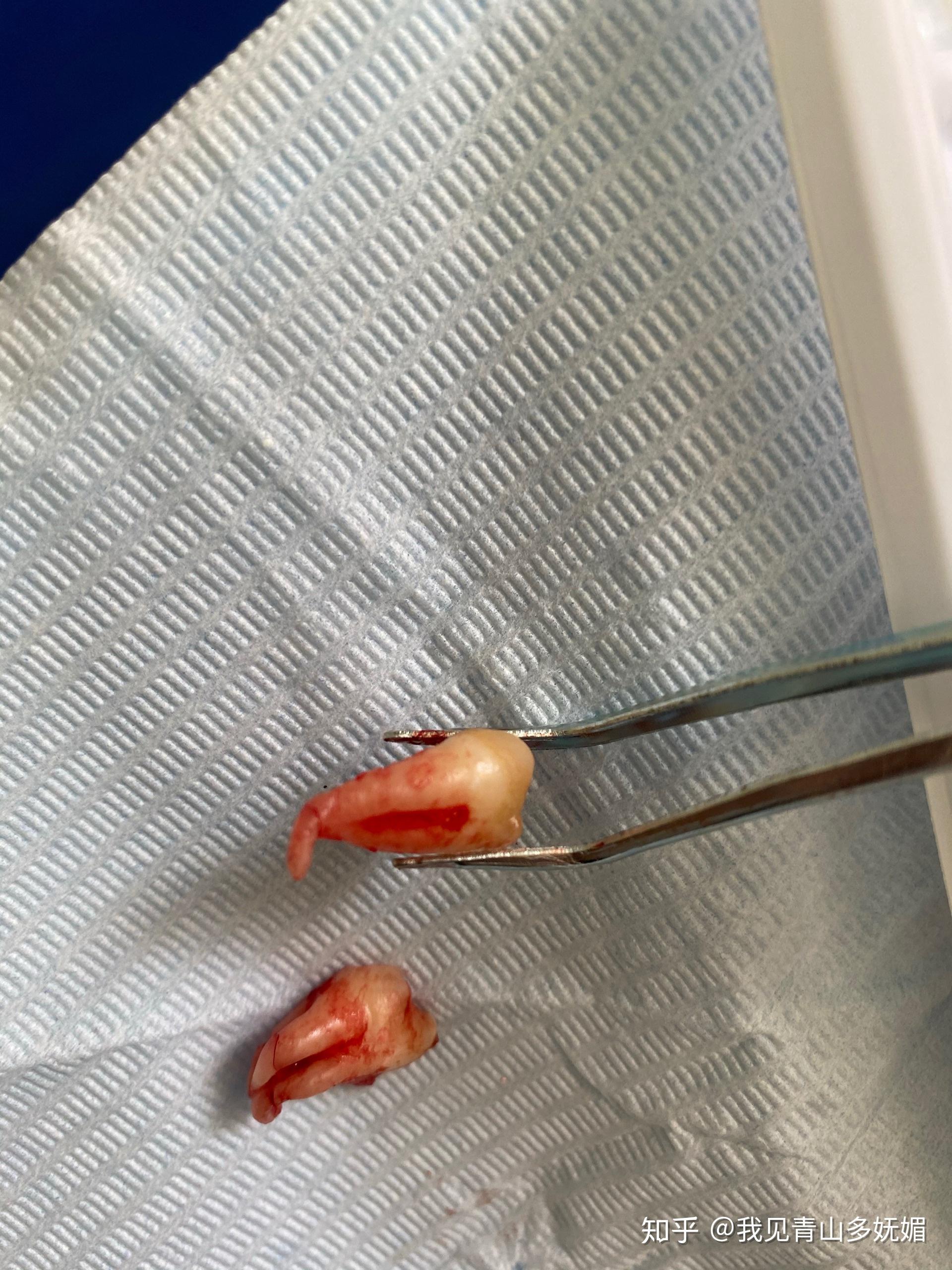 请问智齿牙根是弯的好拔吗? - 知乎