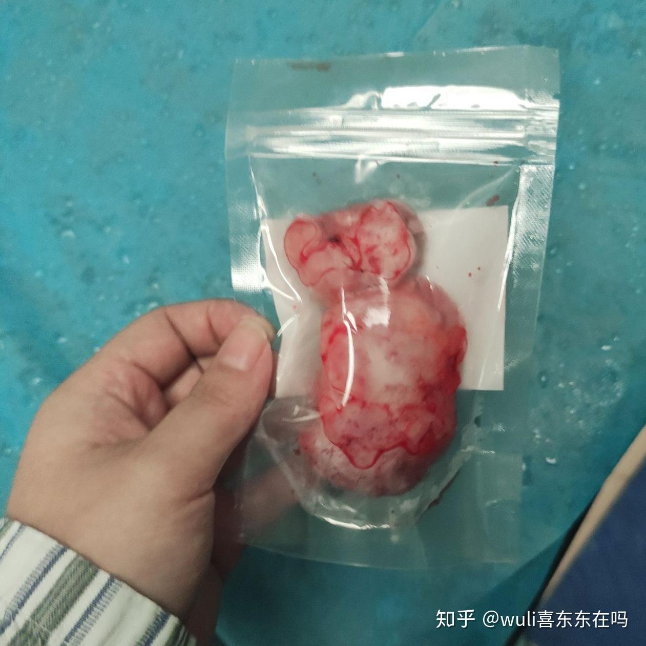 有没有女孩子得过乳腺纤维瘤啊? - 知乎