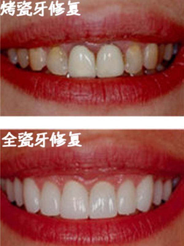 全瓷牙=烤瓷牙?no!一字之差,差别很大!