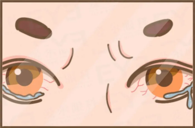 院长答疑丨眼睛老有红血丝我该管吗