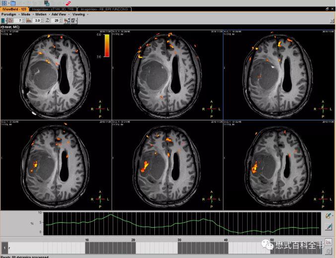 磁共振脑功能成像基础 - 知乎