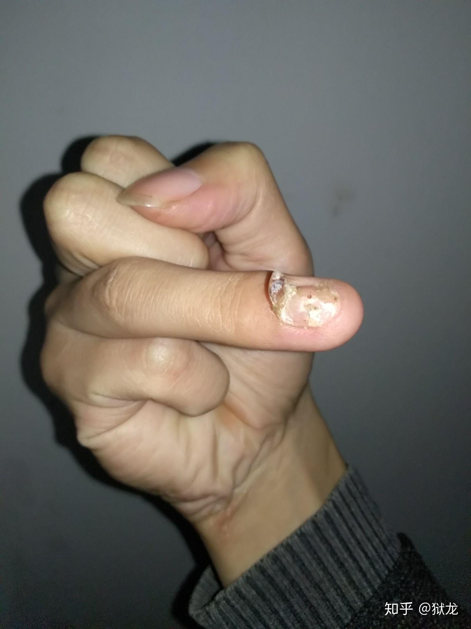 手指甲被夹到,过了一段时间,有黑色的淤血,怎么处理? - 知乎