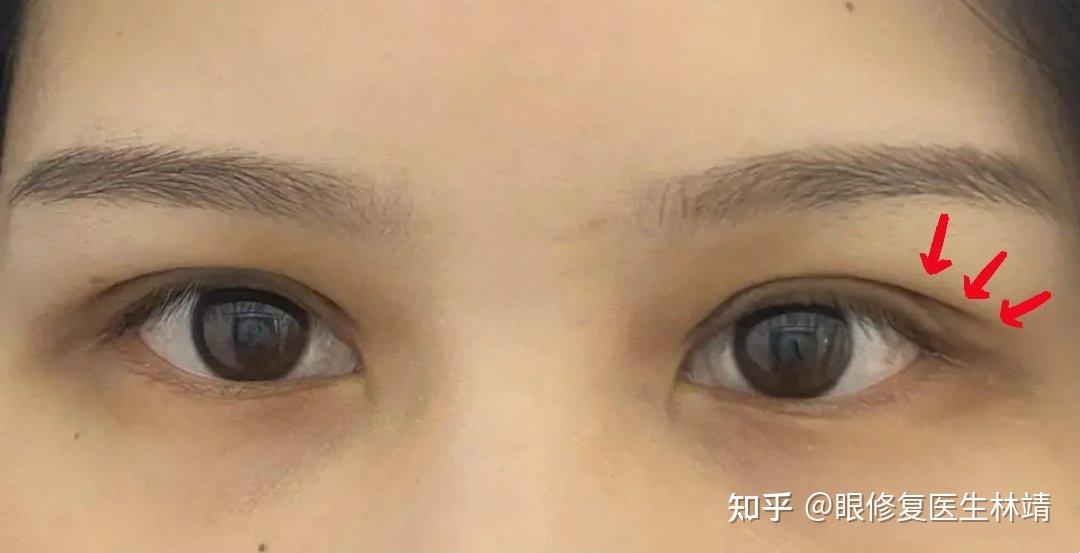 割双眼皮眼尾分叉了怎么办能修复吗