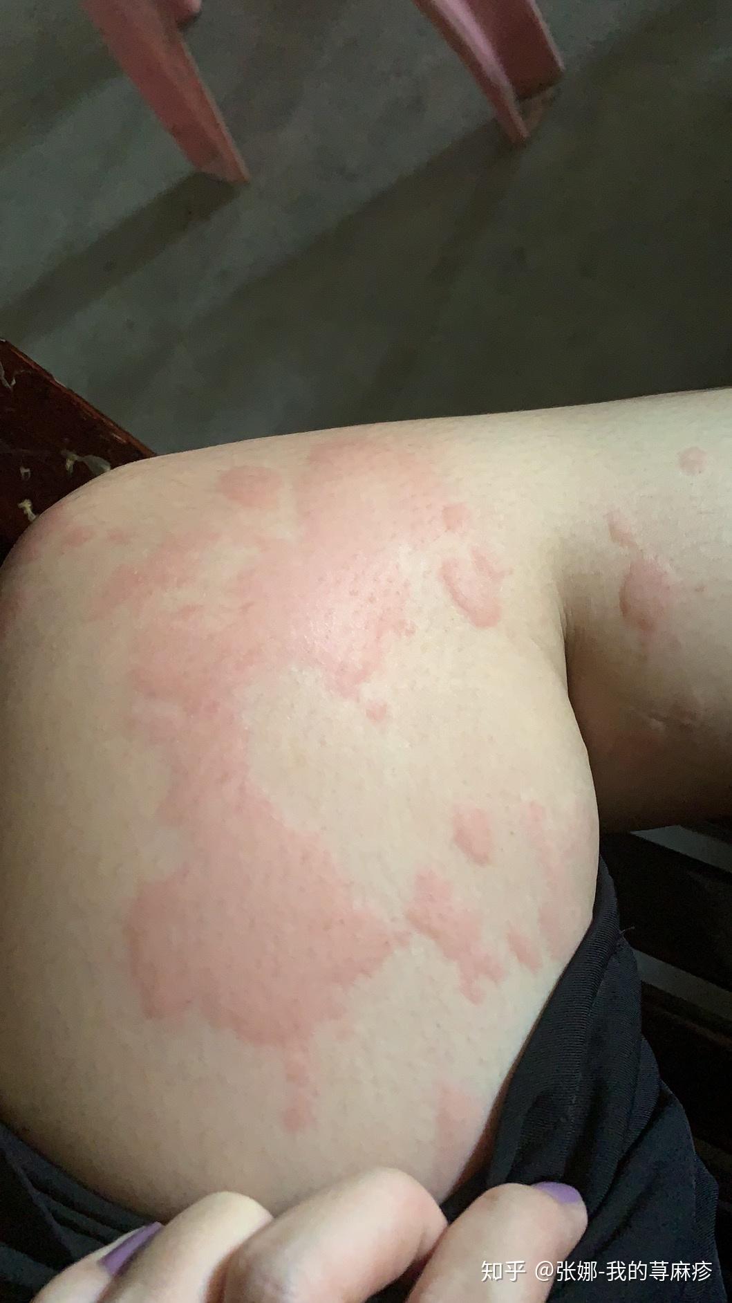 导致荨麻疹的原因是什么