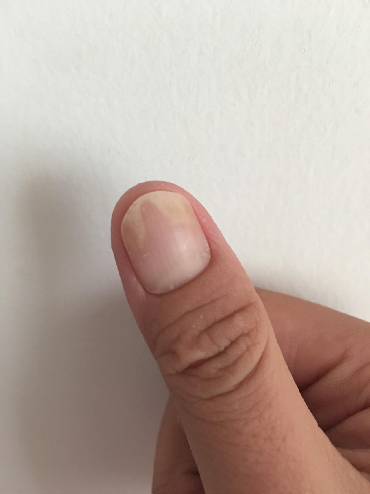 手指甲突然变空了不疼不痒没什么感觉有谁知道是什么病嘛